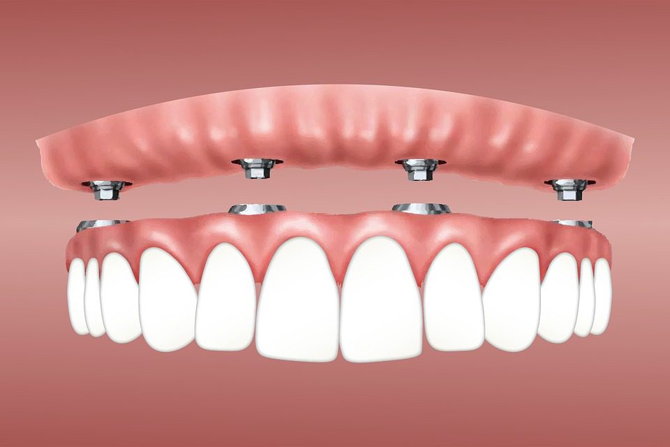 omroeper Vergemakkelijken Dokter Nieuwe tanden in één dag – een nieuwe tandheelkundige techniek - Tandarts  Beins