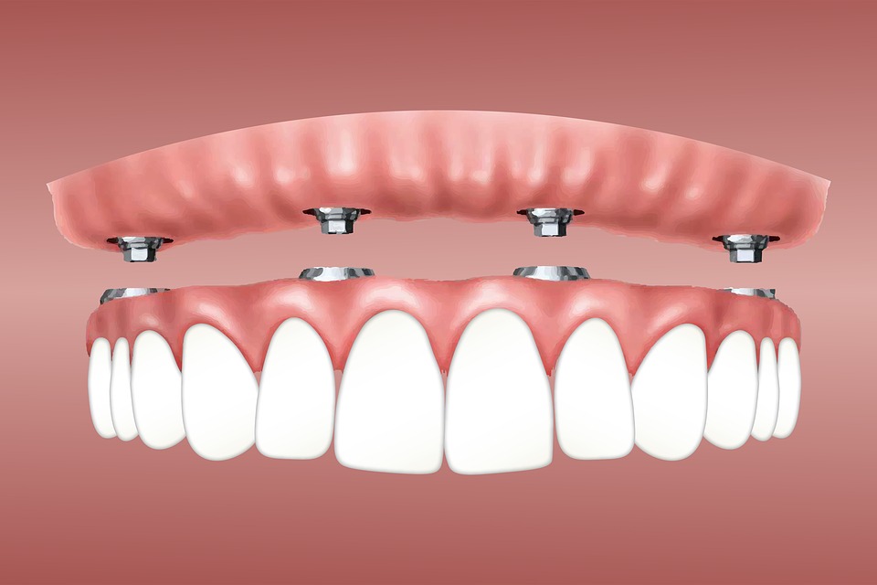 Nieuwe tanden één dag – tandheelkundige techniek - Tandarts Beins